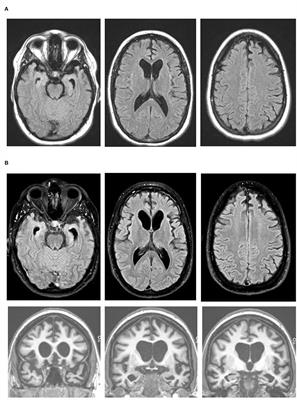 Case Report: Early-Onset Behavioral Variant Frontotemporal Dementia in Patient With Retrotransposed Full-Length Transcript of Matrin-3 Variant 5